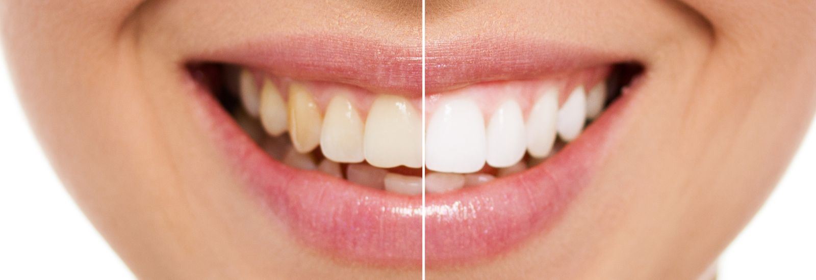 Whitening teeth color shown by a girl