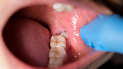 Best Time to Get Your Wisdom Teeth Extracted