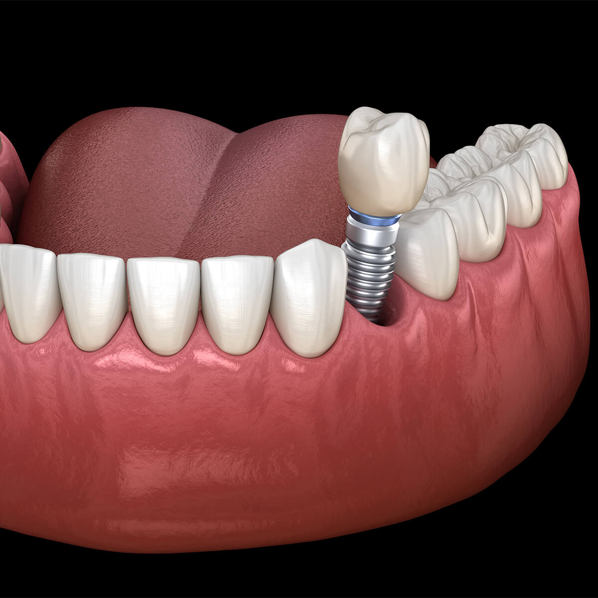 Dental Implant Surgery in Flower Mound TX Area